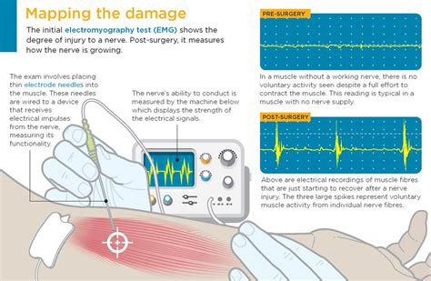 interpreting emg results|emg test shows nerve damage.